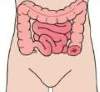Colostomy Colostomy