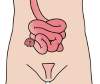 Ileostomy